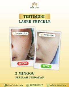 Testimoni-Laser-C-Plus-aufar-clinic1.jpg