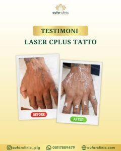 Testimoni-Laser-C-Plus-aufar-clinic3.jpg