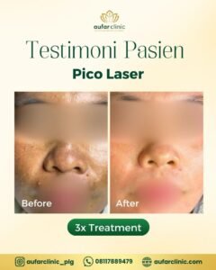 pico laser aufar 1