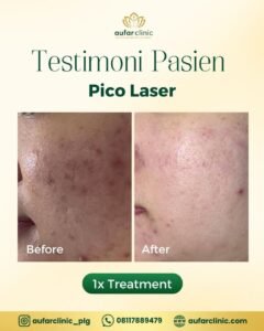 pico laser aufar 2