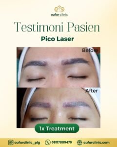 pico laser aufar 3