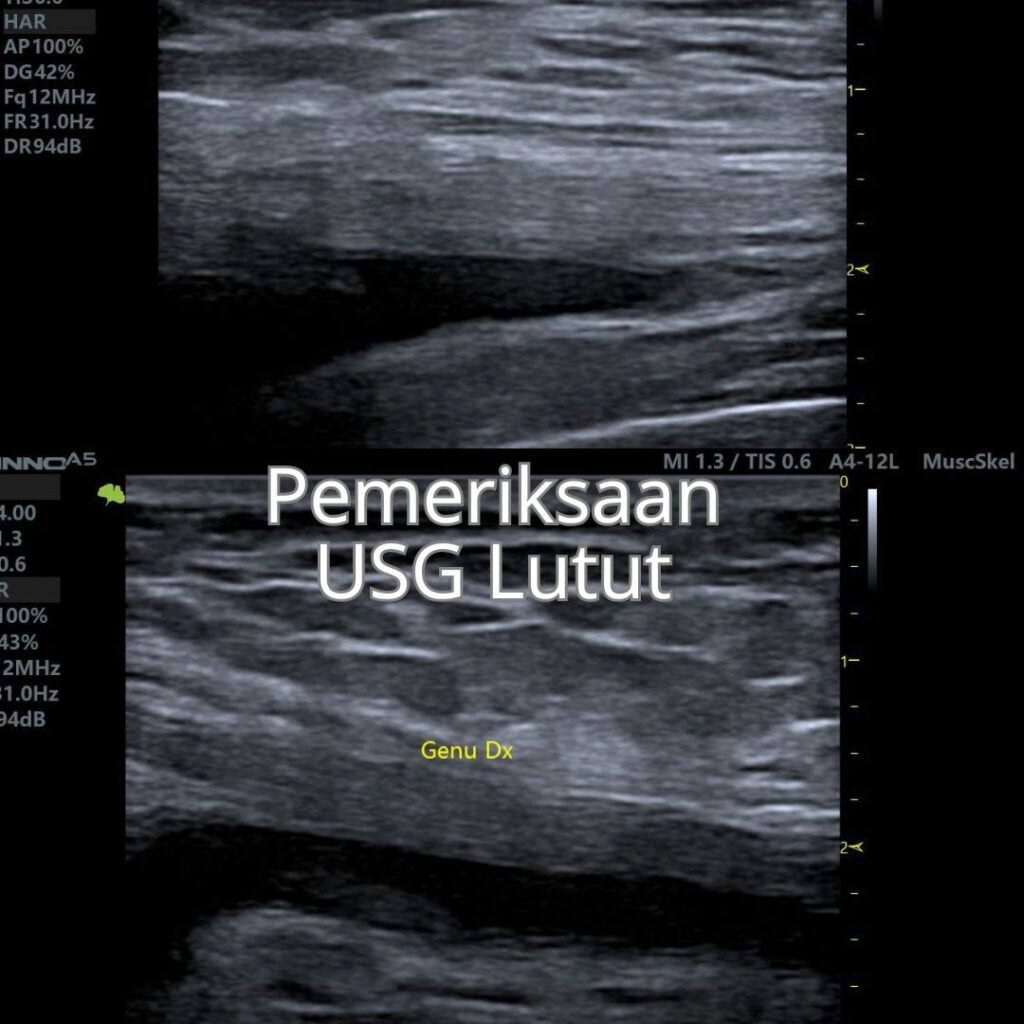 Pemeriksaan USG Lutut 2 aufar
